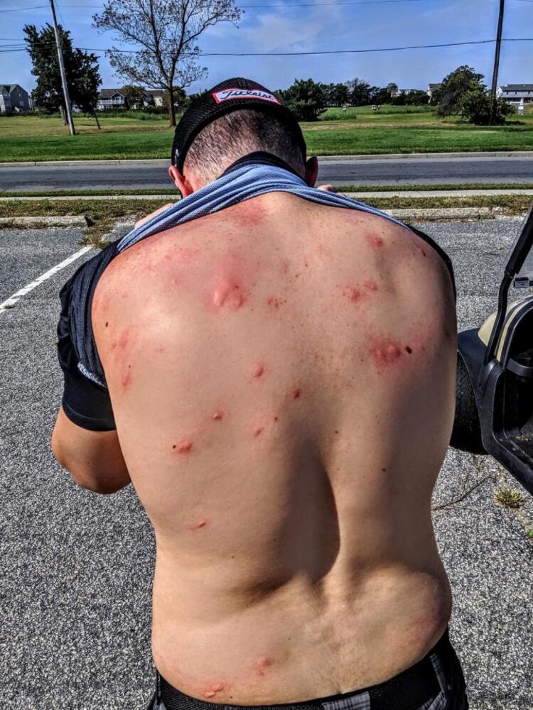 bug bites