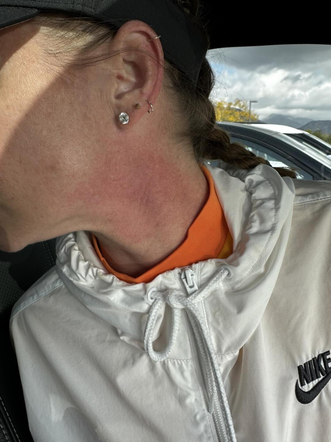 Redness and swollen from getting hit by a golf ball at full drive. (Photo submitted by NikkiJolee on 02/14/2023)
