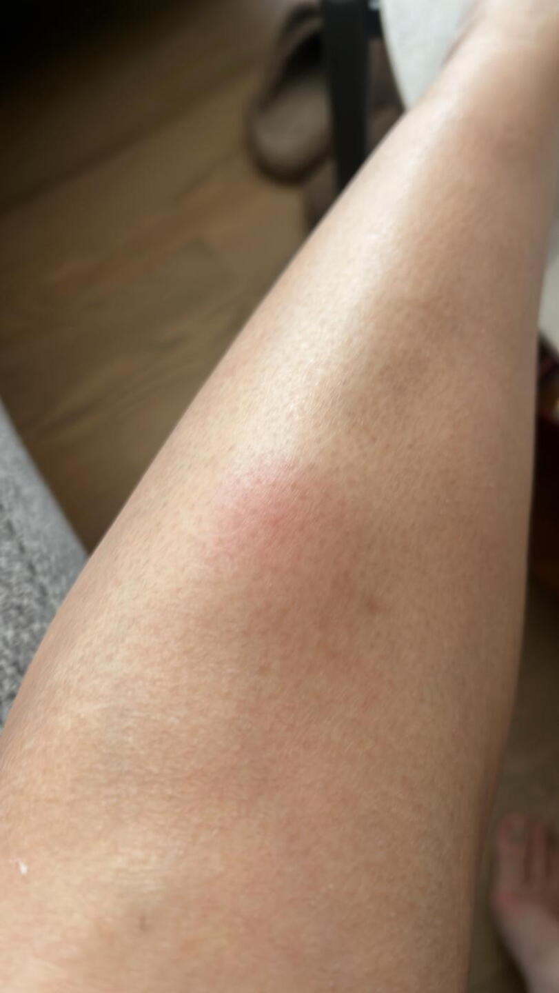 Mosquite bite (Photo submitted by gawdyc on 07/25/2026)