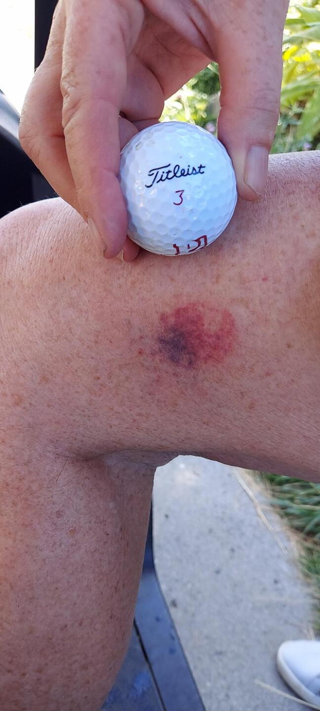 Bruised by incoming ball from group behind us while I was under the bridge. (Photo submitted by alwolff on 07/20/2023)